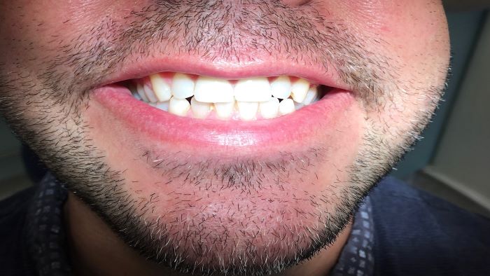 metal free dental crowns