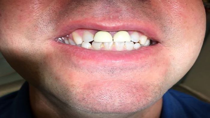 tooth repair