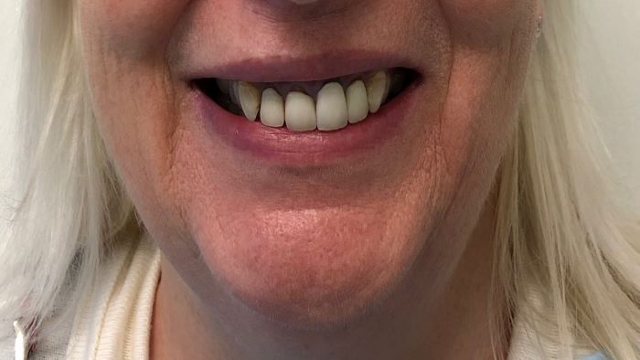 straighter teeth